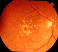 Degeneração-Macular-Relacionada-a-Idade-dmri-DMRI-forma-seca