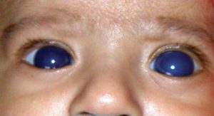 Glaucoma Congênito
